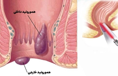 بواسیر