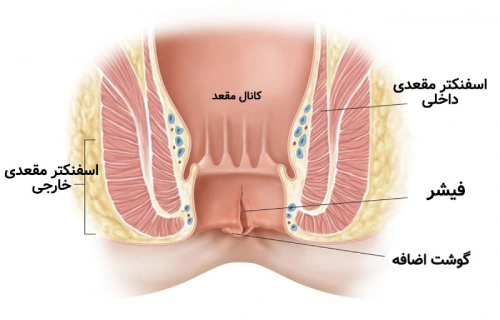 فیشر یا شقاق