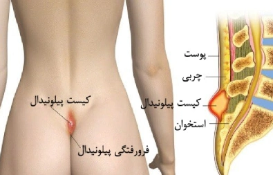 کیست مویی