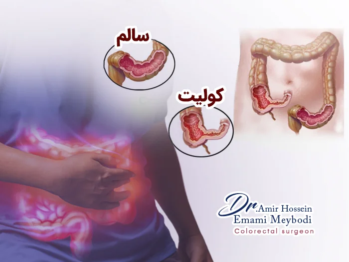 تجربه کسانی که کولیت روده دارند