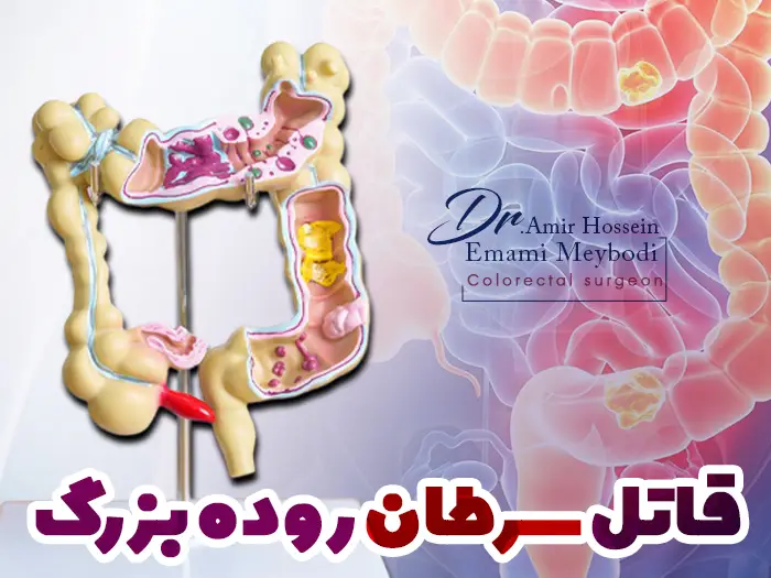 قاتل سرطان روده بزرگ