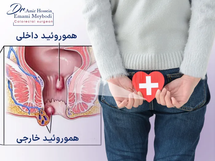 لیزر بواسیر