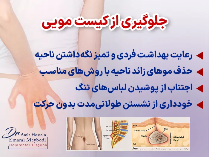 جلوگیری از کیست مویی
