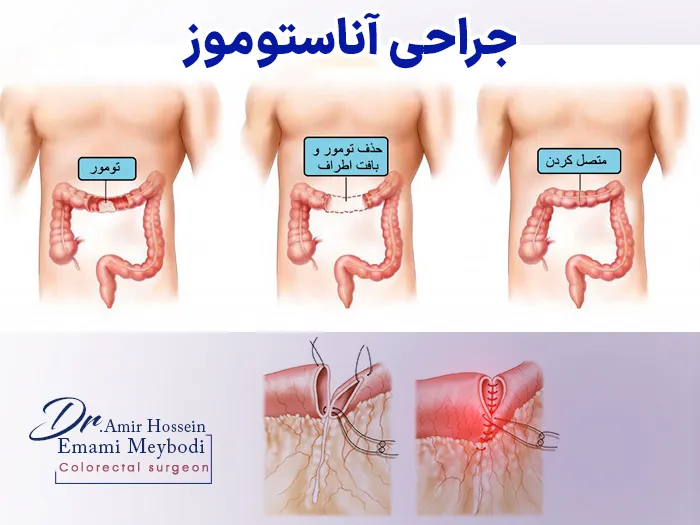 آناستوموز روده چیست