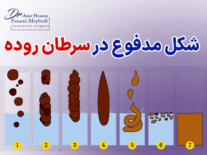 شکل مدفوع در سرطان روده