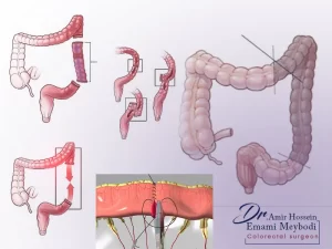 آناستوموز روده