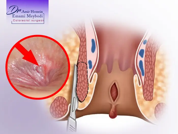زخم مقعد چیست